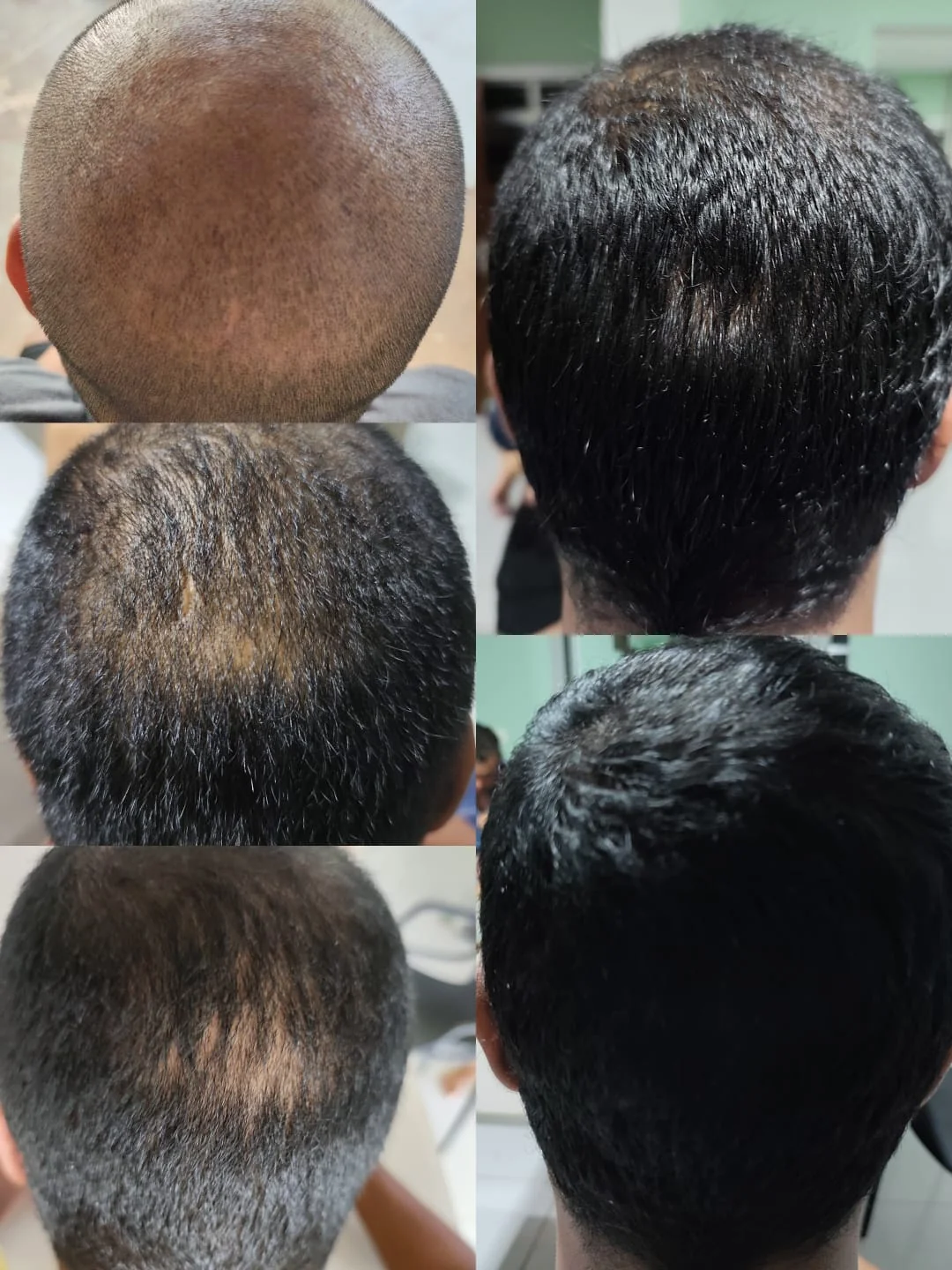 Evolução sequencial em 6 fases de tratamento de alopecia na coroa e vértice capilar