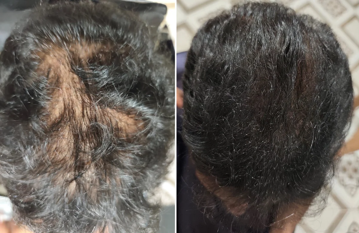Comparativo de antes e depois de fechamento de falha de vértice capilar