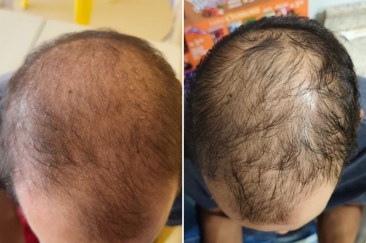 Comparativo de desinflamação de couro cabeludo com dermatite e descamação severa