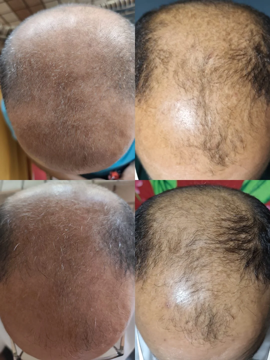 Reativação folicular em calvície de grau avançado em 4 fases