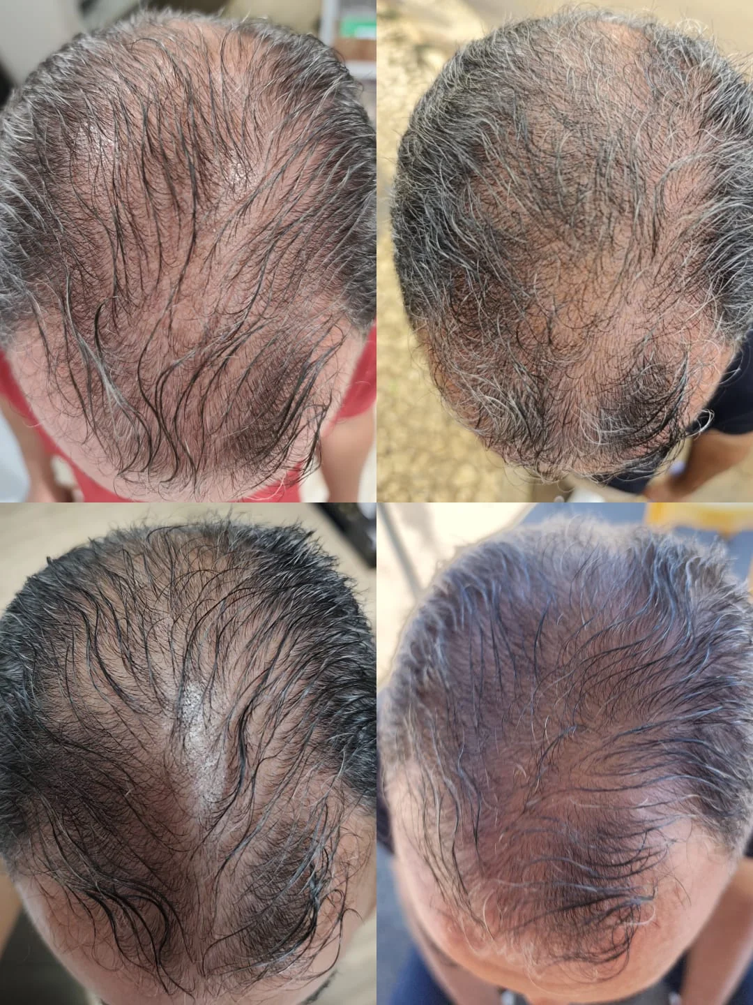 Evolução em 4 fases da linha frontal de paciente grisalho